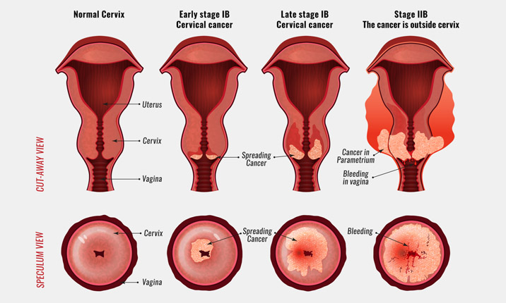 DES-exposed third generation women have increased risks of menstrual aberrations, preterm birth, and possibly ectopic pregnancy - DES Granddaughters - D.E.S is it french organization