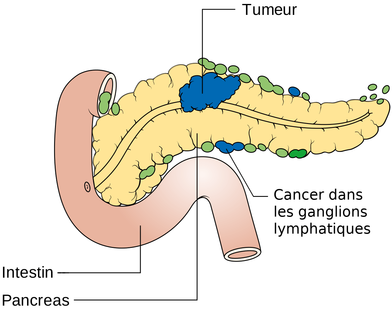 Diagram showing pancreatic cancer in the lymph nodes (N staging) CRUK 178-it